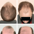 Exploring Medical Treatments for Male Pattern Baldness