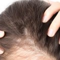 Female Hair Loss and Medical Conditions: Understanding the Link