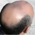 Genetics and Male Pattern Baldness: Understanding the Link