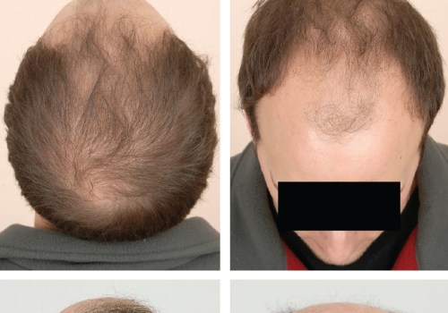 Exploring Medical Treatments for Male Pattern Baldness