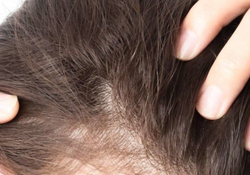 Female Hair Loss and Medical Conditions: Understanding the Link