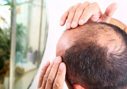 Lifestyle Factors and Male Pattern Baldness: What You Need to Know