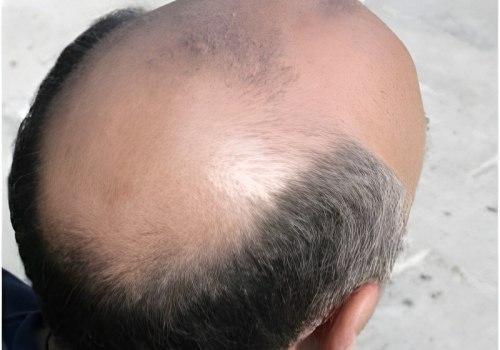 Genetics and Male Pattern Baldness: Understanding the Link