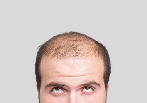 Hormonal Changes and Male Pattern Baldness: Understanding the Link