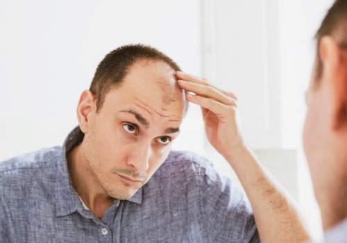 Natural Remedies for Male Pattern Baldness: A Comprehensive Guide